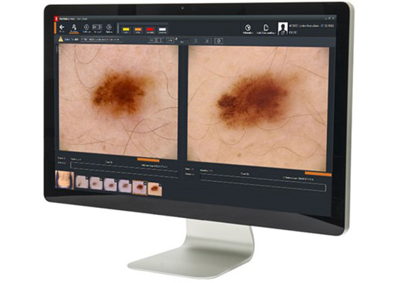 Mole mapping Img2