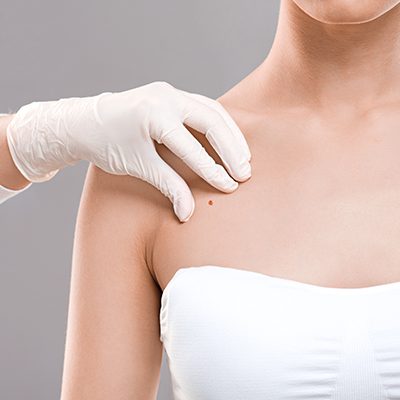 Dermatologist examining birthmark on woman body