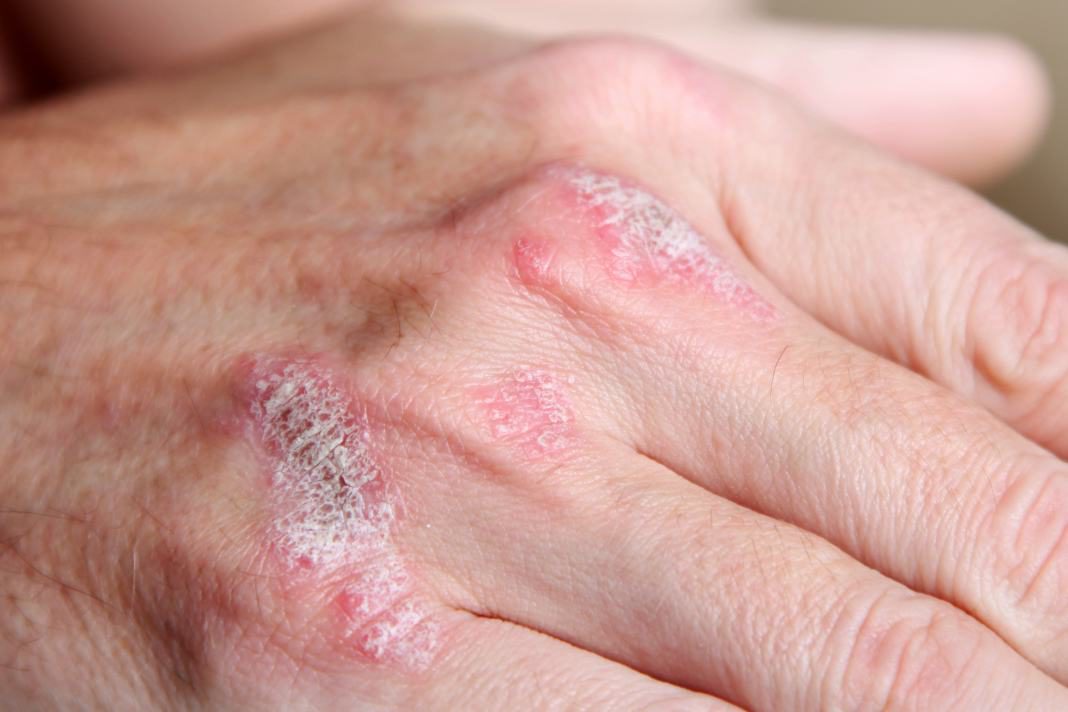 3-psoriasis-1068x712