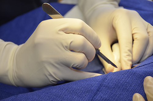 CSO surgery
