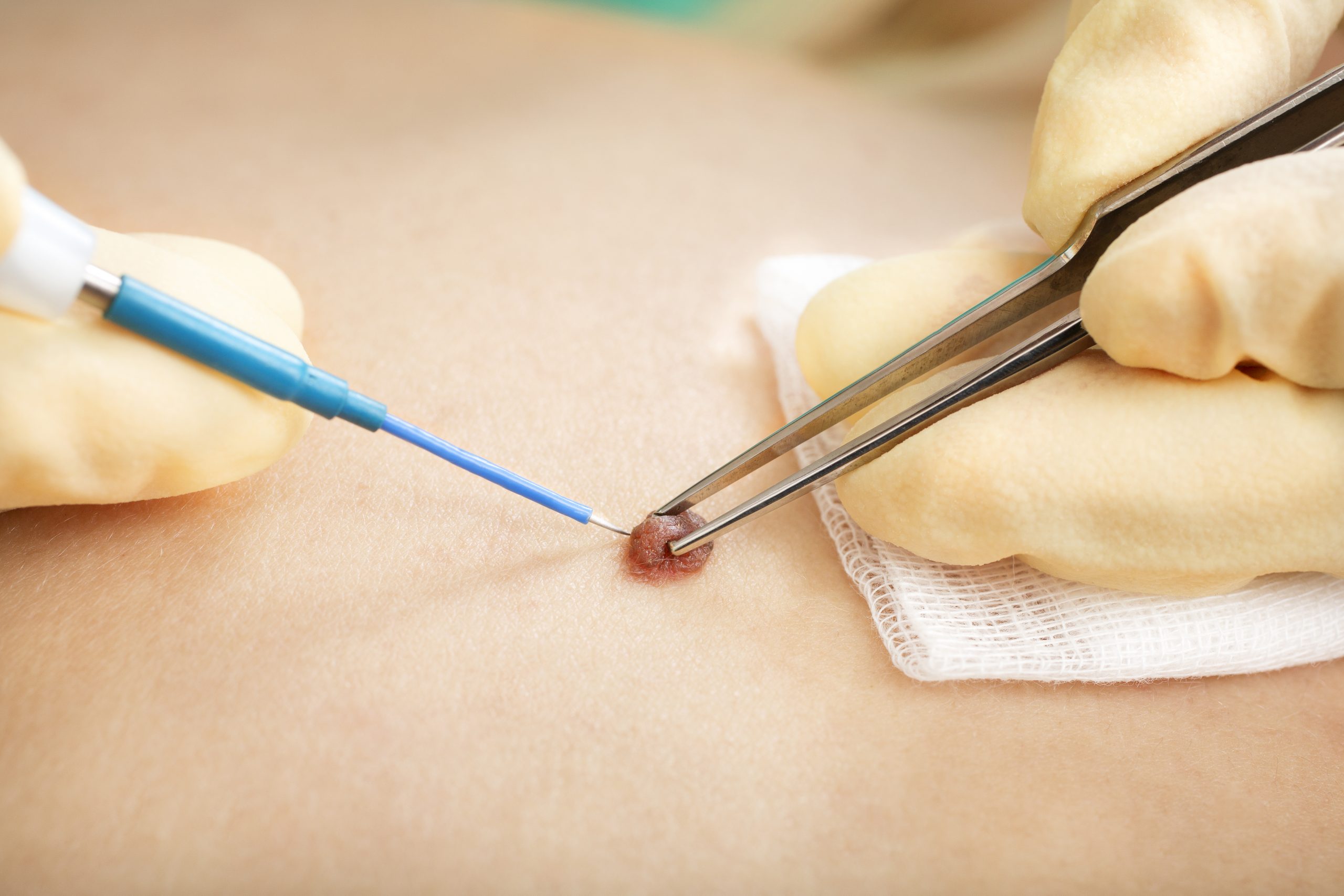 Electrosurgery skin