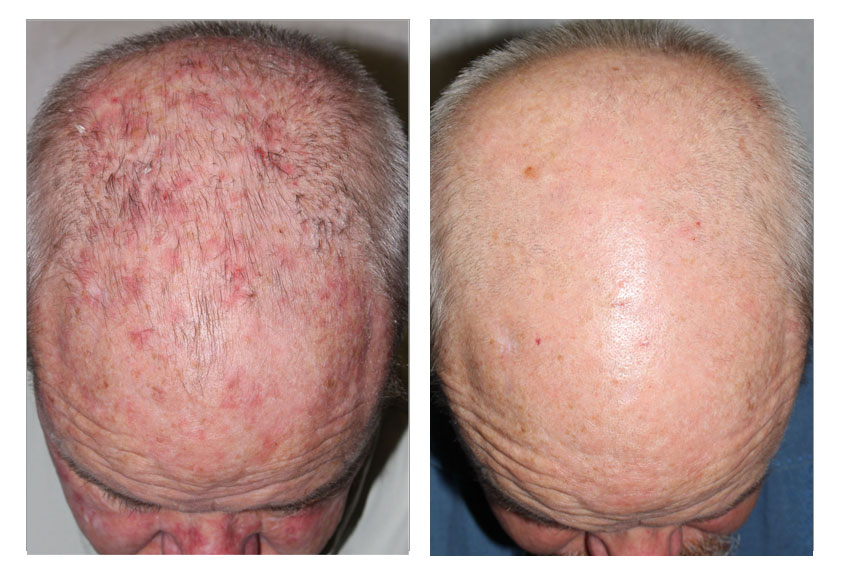 Before & After PDT scalp