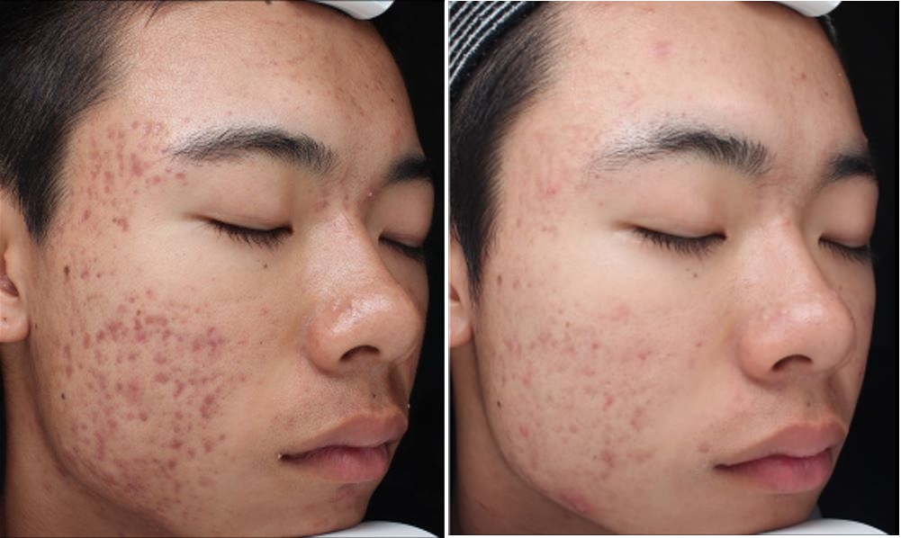 Tixel-before-after