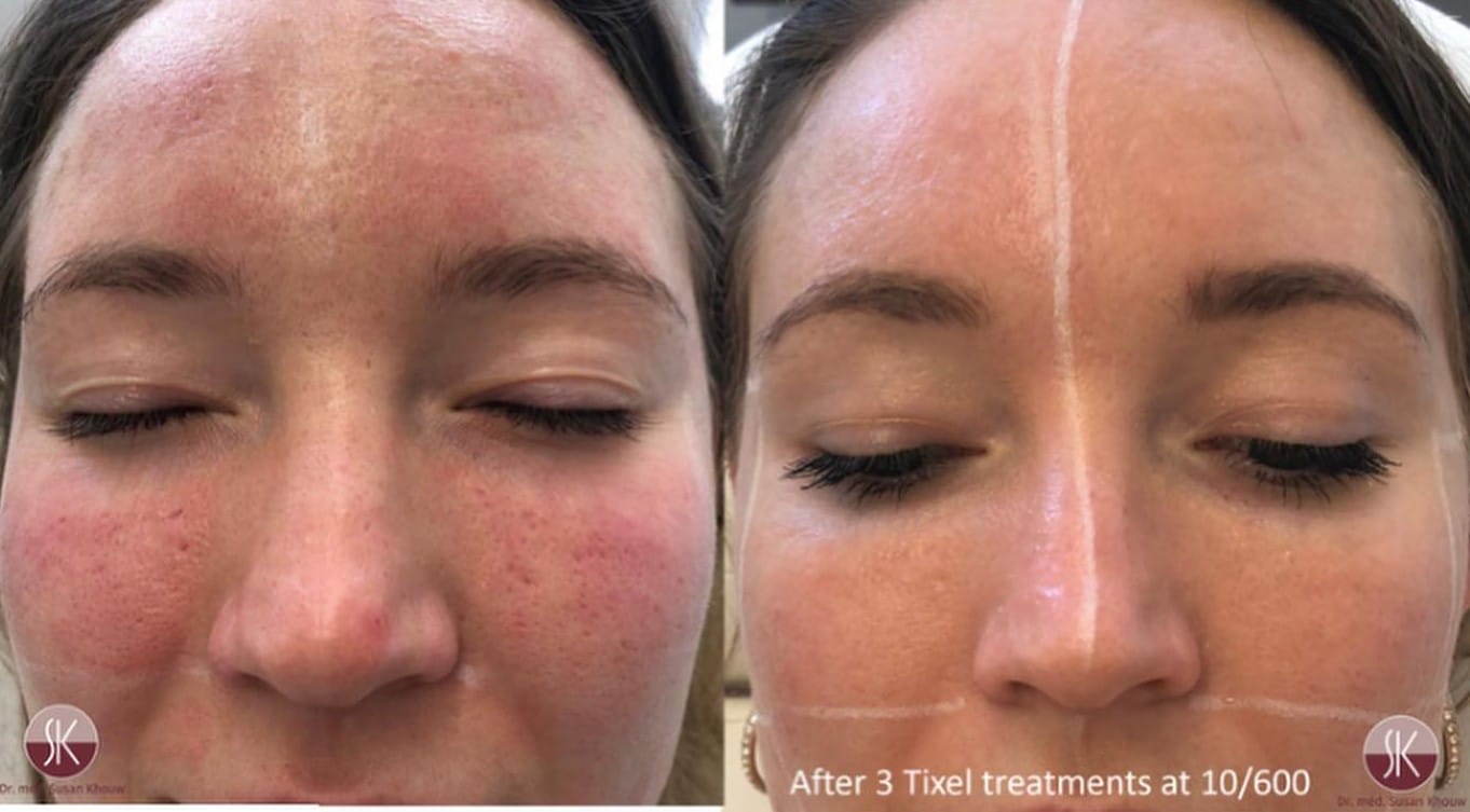 tixel-face-treatment-2